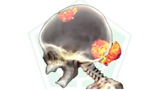 Osteosarcoma  Metástasis [upl. by Yearwood]