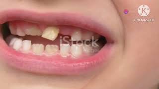 Teeth splintingLoose teeth treatmentSinghs Dental Clinic DhanbadDentist in DhanbadPeriodontist [upl. by Schnurr]