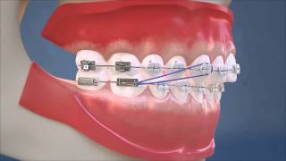 Class II Elastics  Lateral View HD Edition [upl. by Murial]