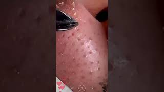 Skincare  Blackheads Removal 158 skincare skincare blackheads blackheads [upl. by Akerdnuhs102]