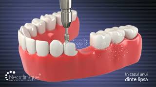 Implant dentar versus punte dentara [upl. by Jeremiah]