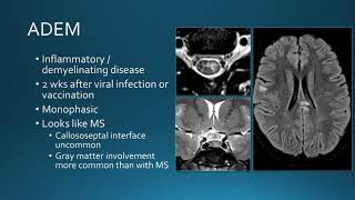 Intradural spinal inflammatory lesions [upl. by Lemar772]