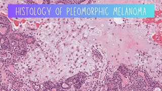 Histology of Pleomorphic adenoma [upl. by Brace]