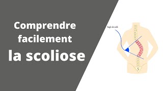 Comprendre facilement la scoliose  que signifie déformation vertébrale dans les 3 plans🤔 [upl. by Margaretta]