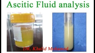 Ascitic fluid analysis تحليل السائل البريتوني [upl. by Bergh]