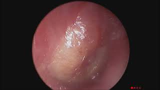 An Established Acute Otitis Media Causing Ear Pain And Reduced Hearing [upl. by Nnyleuqaj]