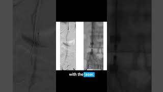 Quick Guide to Laser Sheath for Filter Retrieval with Dr Noor Ahmad medicaleducation [upl. by Dieter350]