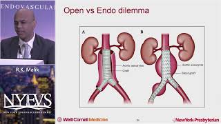 Endovascular Management of Infrarenal Abdominal Aortic Aneurysms in 2022 R K Malik Endo Fellow [upl. by Cyma416]