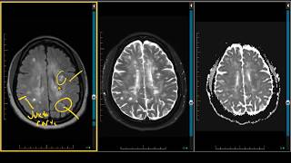 Demyelination Case Review  ADC Negative Multiple Sclerosis [upl. by Tatianas]