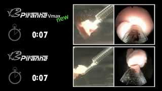 Piranha laser enucleation system from Richard Wolf [upl. by Livy]