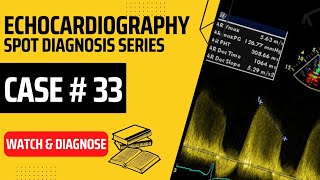 Case 33 A 40 y old patient with Marfan Syndrome  Case Series echocardiography echo cardiology [upl. by Elocan]