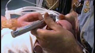 737 Intubation of an Infant [upl. by Melodie]