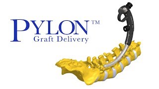 Pylon MIS Posterolateral Graft Delivery System  Preview Animation [upl. by Loredo]