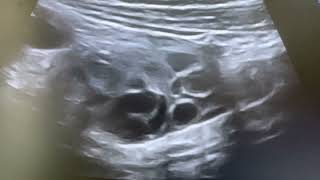 Ultrasound of acute colitis in 11 years girl [upl. by Debora]