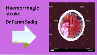 haemorrhagic  stroke  subarachnoid hemorrhage subdural extradural hematoma [upl. by Drhcir]