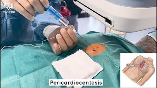 Pericardiocentesis [upl. by Ahael272]