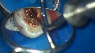 furcation perforation closure  закрытие фуркационной перфорации [upl. by Tinaret]