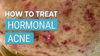 How I CLEARED my hormonal acne NATURALLY  730 day plan you can try [upl. by Stets]