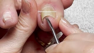 👣Pedicure How To Squeezed Big Toenails Journey👣 [upl. by Ezaria355]