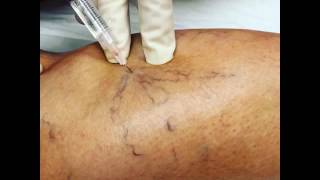 Sclerotherapy with asclera [upl. by Gratia]