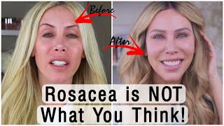 3 AtHome Steps to CURE Your Rosacea for GOOD No Doctor Needed [upl. by Yablon]