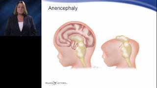 Quick Concepts  Acrania vs Anencephaly [upl. by Boeke]