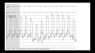 Hemodynamics 4 Constrictive pericarditis case studies Elias Hanna Univ Iowa [upl. by Matilda945]