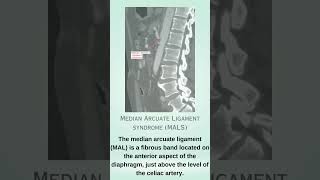 Median arcuate ligament syndrome  MALS [upl. by Teleya]