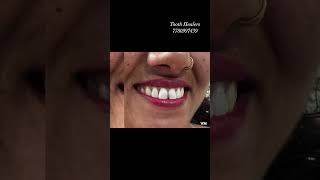 confidentsmile veneers smiledesign toothhealers dentitsofjammu smile smilemakeover veneers [upl. by Eisserc]