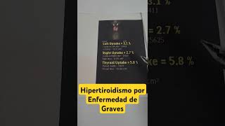 Gammagrafía de tiroides en hipertiroidismo por enfermedad de Graves [upl. by Hsemar]