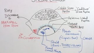 High Yield Topic Vernal Kerato Conjunctivitis amp Trachoma [upl. by Suzy]