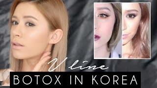 V LINE SURGERY  BOTOX IN KOREA My experience [upl. by Susannah]