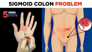 Sujok Treatment For Sigmoid Colons Problems😖🔥🔥🔥 [upl. by Nosreve]