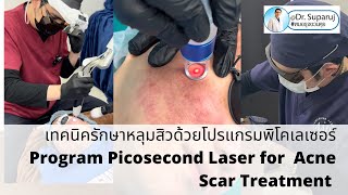 เทคนิครักษาหลุมสิวด้วยโปรแกรมพิโคเลเซอร์โปรแกรม Discovery Pico Laser for Acne Scar Treatment [upl. by Wadesworth877]