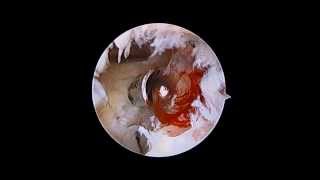 Elbow Arthroscopy  Osteoarthritis  Nicky Leung MD [upl. by Akehsar]