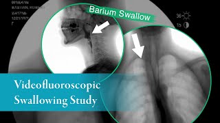 Barium Swallow Barium Esophagram AnteriorPosterior View [upl. by Narahs]