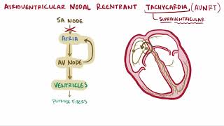 Atrioventricular reentrant tachycardia AVRT amp nodal reentrant tachycardia AVNRT [upl. by Adnilem]