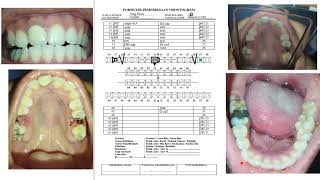 Pengisian Odontogram Kemenkes dan interpol [upl. by Tanah602]