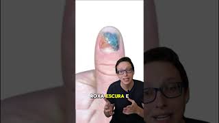 Hematoma Subungueal 💅😱 medicina medico curiosidades saude enfermeira enfermagem saúde [upl. by Illek313]