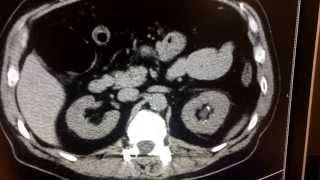 CT scan for kidney stone [upl. by Llennhoj]