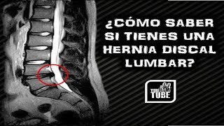 COMO SABER SI TIENES UNA HERNIA DISCAL LUMBAR  SIGNOS Y DIAGNOSTICO DE UNA HERNIA DISCAL [upl. by Hynes]