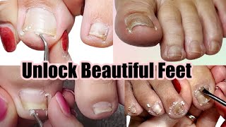 Pedicure Tutorial on Deep Compacted Ingrown Toenail [upl. by Claudine26]