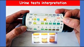 Lecture 72 Urine Analysis Tests  Interpretation [upl. by Herculie536]