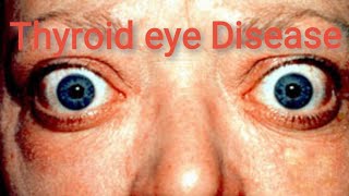 Orbit  Thyroid Eye Disease Graves ophthalmopathy  Part 4 [upl. by Llemaj]