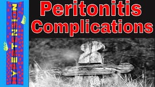 Diverticulitis to Peritonitis  Peritonitis and Sepsis Complications [upl. by Nnyltak]