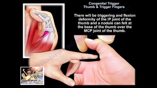 Congenital Trigger Thumb  Everything You Need To Know  Dr Nabil Ebraheim [upl. by Nyra529]