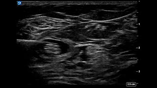 UltrasoundGuided Popliteal Sciatic Nerve Block  Singel handed user [upl. by Llehcnom]