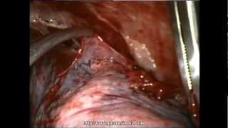 Thoracoscopy VATS Decortication in stage 2 empyema Delhi Noida India [upl. by Nnaer263]