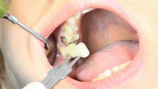 Prótese Fixa Confecção de coroa total em cerâmica sistema Cerec CADCAM [upl. by Anitserp466]