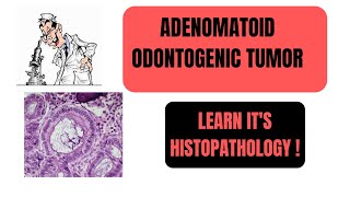 ADENOMATOID ODONTOGENIC TUMORAOT  PART2  LEARN ITS HISTOPATHOLOGY I ORAL PATHOLOGY [upl. by Enelegna673]